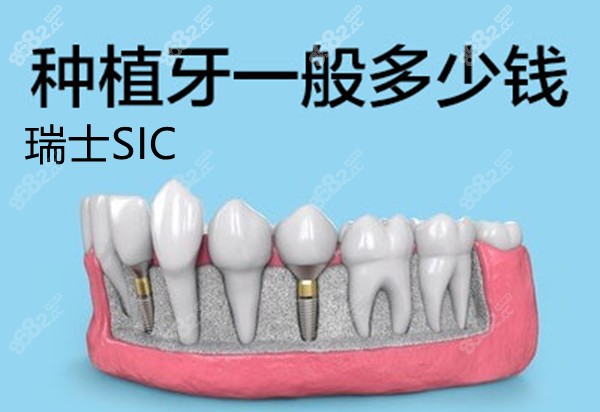 瑞士SIC种植牙一般多少钱