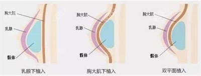 刘真宏医生隆胸的技术优势3