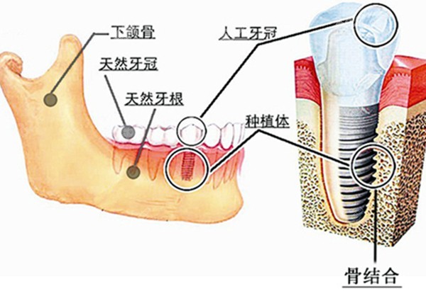 种植牙的解剖图