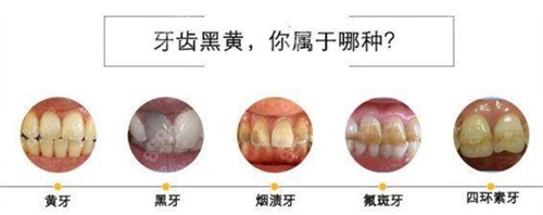 需要做牙齿美白的类型