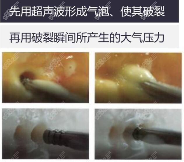 广州韩后整形维密天使脂雕UAL超脂塑体雕术原理