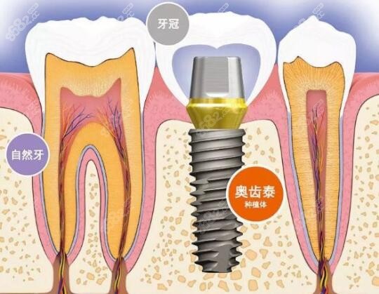 韩国奥齿泰种植体的优势