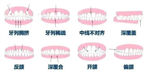 需要正畸的牙齿类型