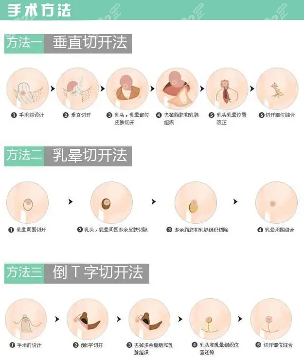 西安缩胸手术哪个医院好西京国际乳房缩小做得好费用不高