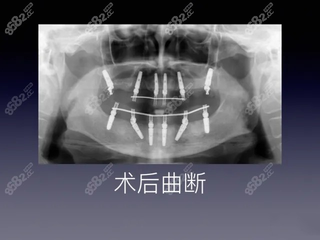 全口种植牙上下6颗的位置