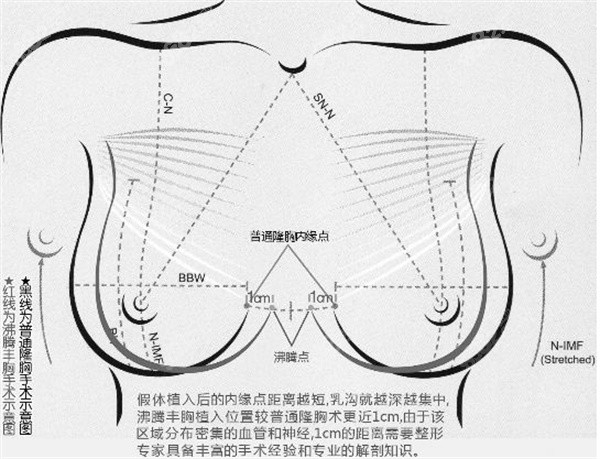 林沸腾隆胸