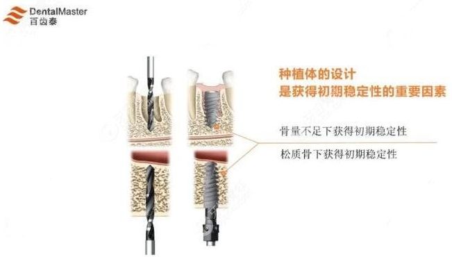 百齿泰种植体表面设计优势