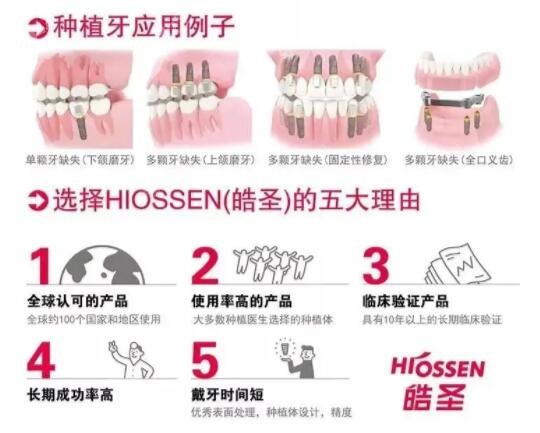 美国皓圣种植体的优势