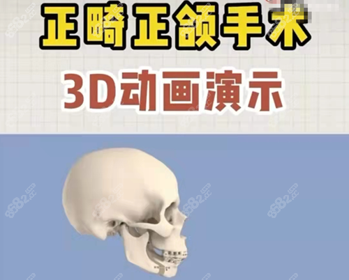 薛国初正颌手术价格