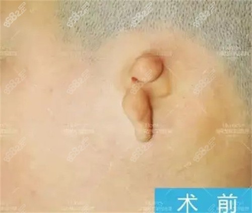 耳再造術(shù)前示意圖