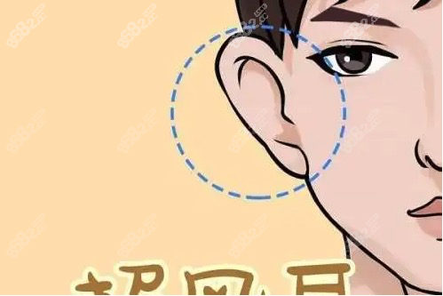 杭州招风耳矫正哪家好