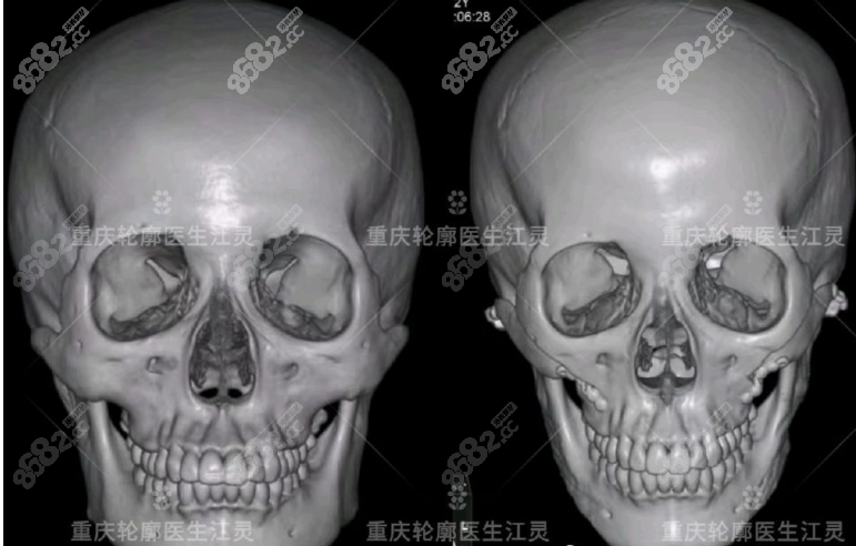 重庆江灵医生磨骨真人实例