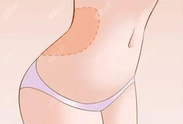 南京华美裴旭芳做腰腹吸脂怎么样