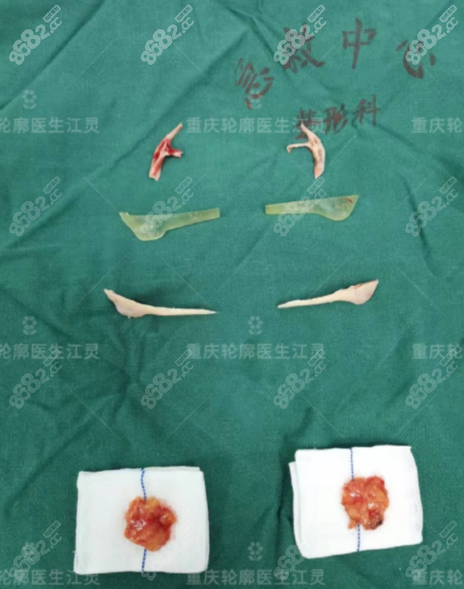 重庆江灵医生做轮廓手术