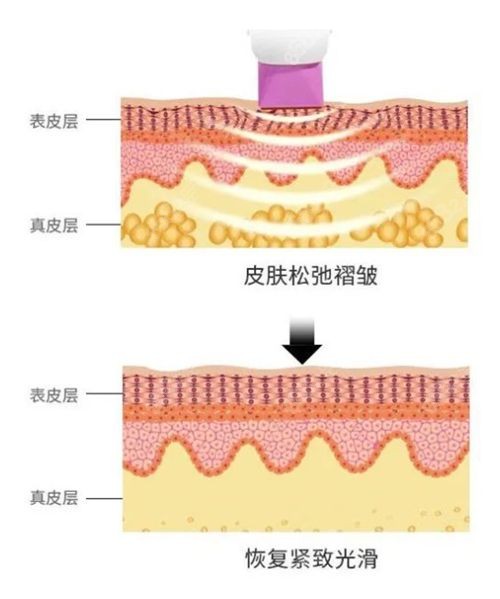 热玛吉通过加热刺激皮肤真皮层产生胶原蛋白.jpg