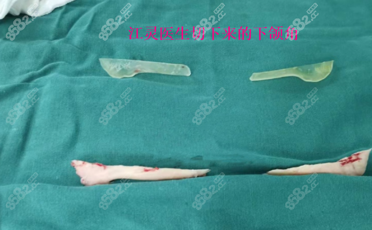 重庆江灵医生做下颌角手术怎么样？