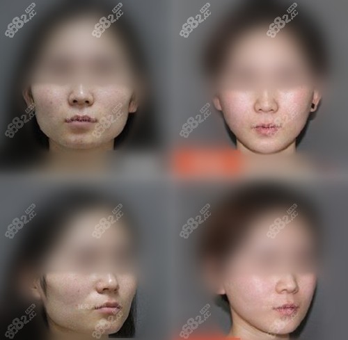 北京圣嘉新張笑天改臉型真人實(shí)例