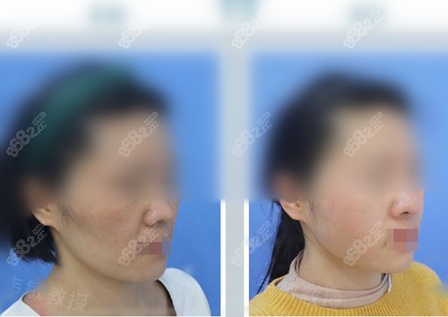 <!--<i data=20240705-sp></i>-->改臉型術(shù)前術(shù)后對比