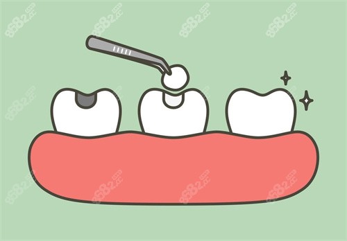 牙齿修复示意图