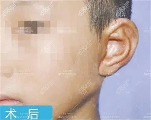 耳再造術(shù)后示意圖