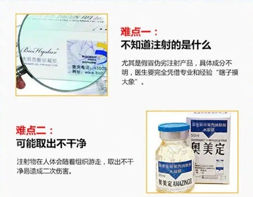 北京煤医解释异物取出难点