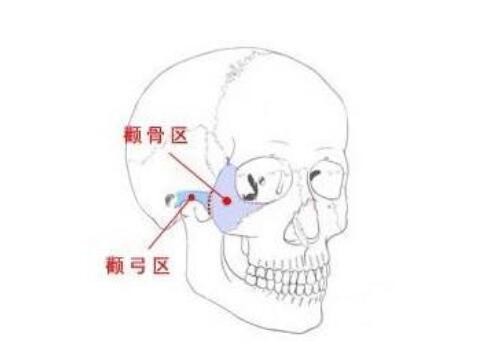 颧骨手术