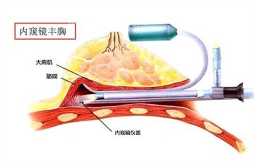 内窥镜隆胸原理