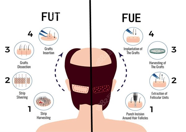 植发技术fue和fut的区别