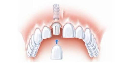 微创种植牙技术示意图