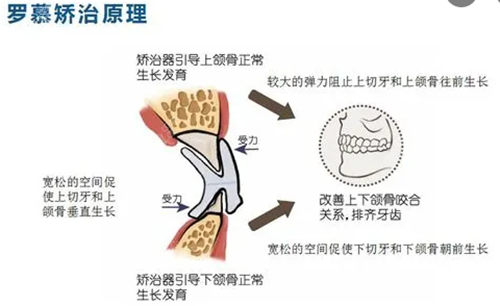 罗慕咬合诱导矫正