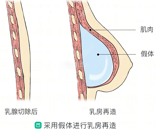 假体乳房重建术