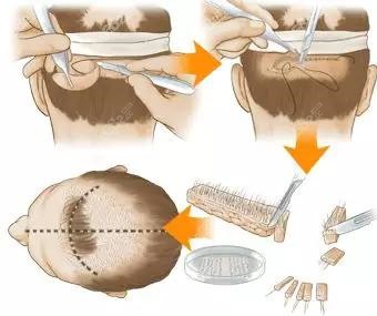 fut植发是什么？请看手术步骤