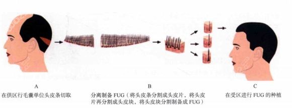 FUT植发技术过程示意图