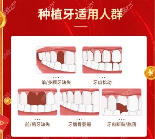 种植牙适用人群