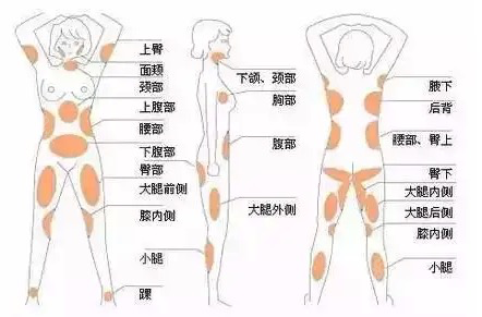 吸脂部位展示图