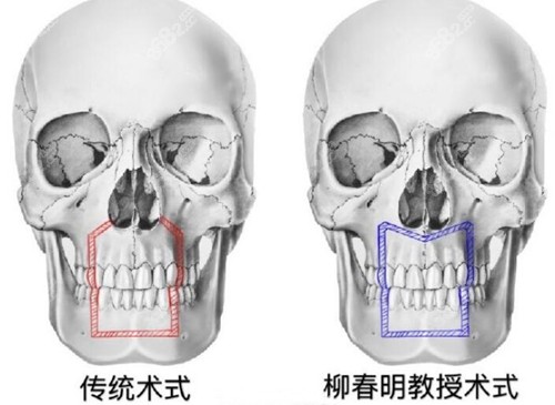 柳春明正颌手术和传统手术区别