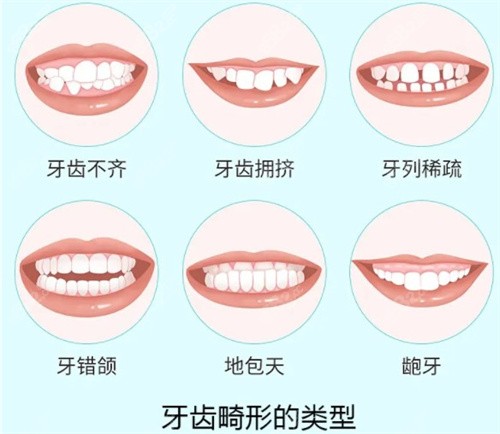 牙齿畸形的类型