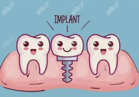 杭州富阳种植牙收费贵不贵