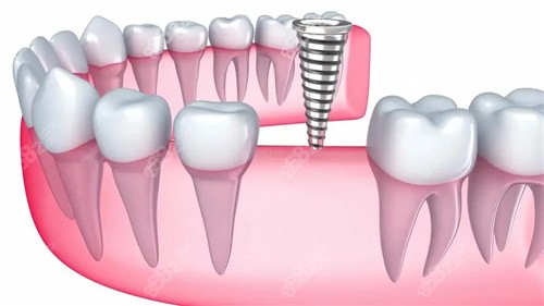 泉州柏德口腔的种植牙技术高