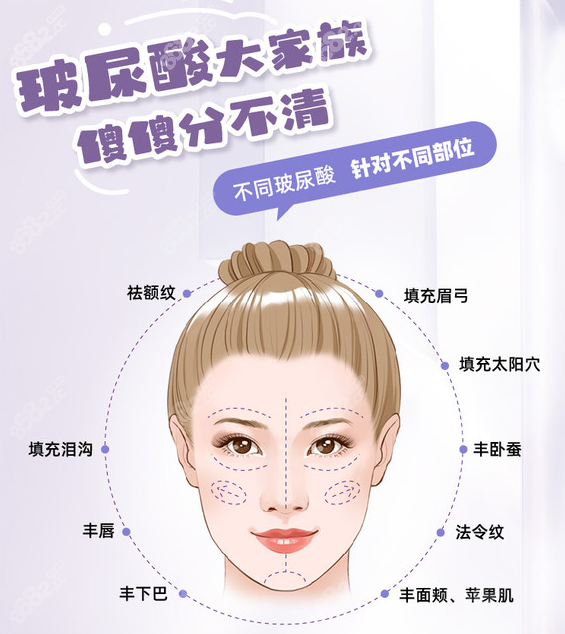 淄博注射玻尿酸隆鼻多少錢