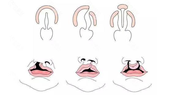 唇腭裂修复的症状