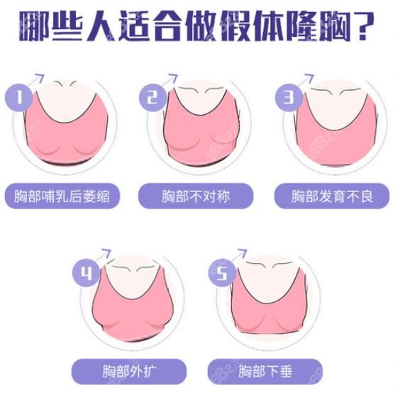 法芮娅假体隆胸可以改善哪些胸部问题