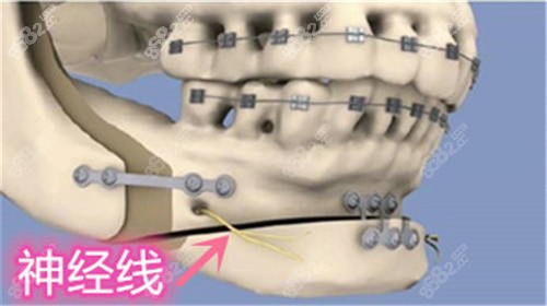 首尔丽格的下颏截骨前移