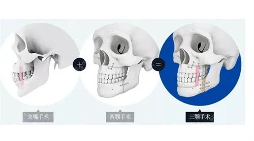 正颌手术示意图