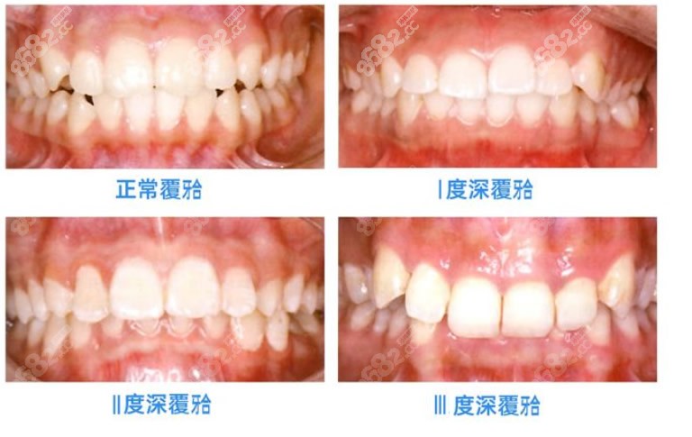 牙齿深覆合的图片对比图片