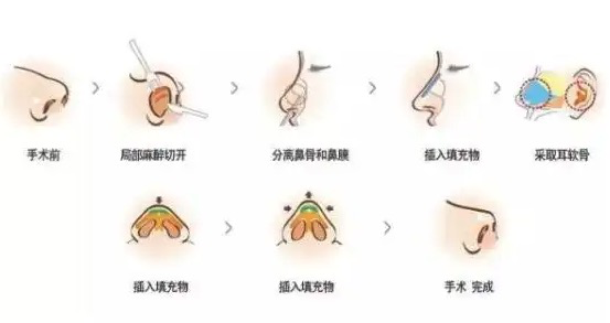 李開亮做鼻子就是好