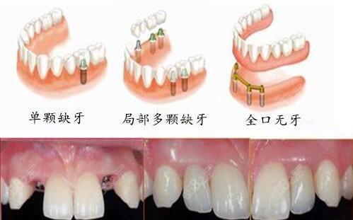 韶关牙乐康口腔种植牙怎么样