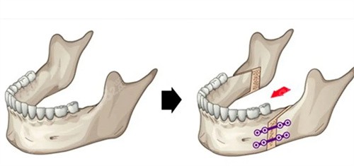正颌手术示意图