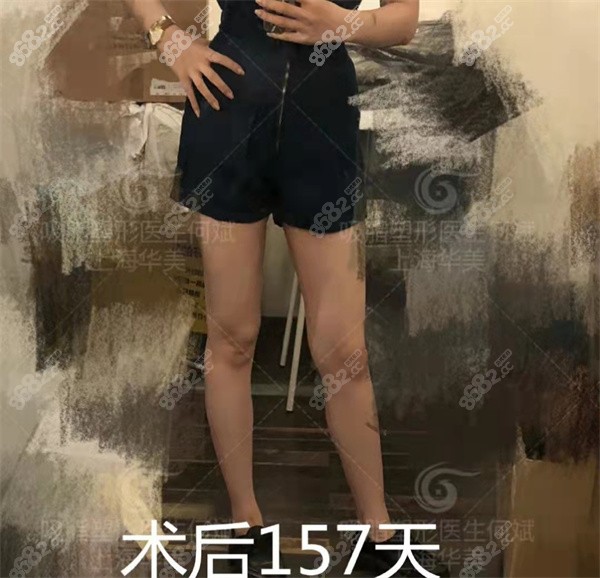 上海华美何斌吸脂