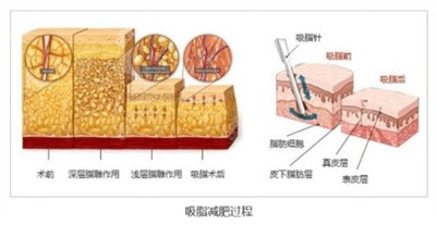 彭涛医生吸脂的技术优势4